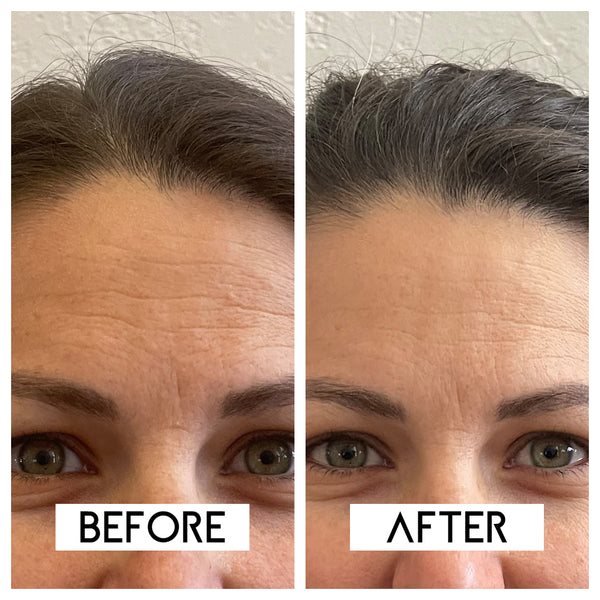 Alternative to botox with line smoothing effects